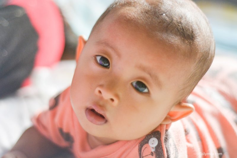 신생아 귀 연골 유연성과 교정 시기 관련 이미지